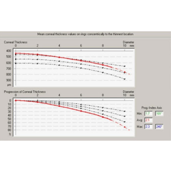 Evaluación de Queratocono con Pentacam