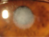 trasplante de cornea cicatriz preoperatoria