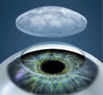 trasplante de cornea opaca