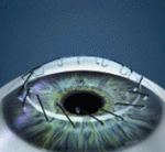 cornea trasplantada