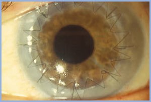 cornea trasplantada