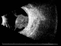 Ecografia ocular, imagen de melanoma de coroides