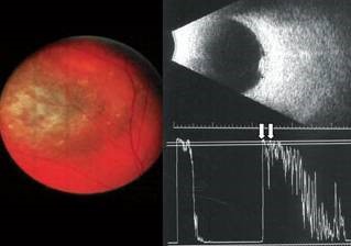 Ecografia ocular, imagen de nevus de coroides