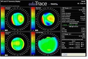 Estudio para cirugía refractiva en presbicia