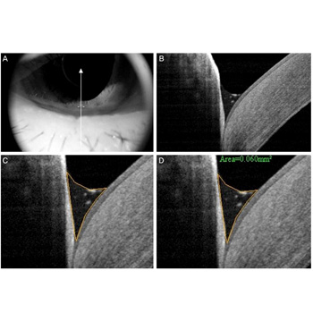 Evaluación del menisco lagrimal mediante Tomografía Óptica Coherente. 