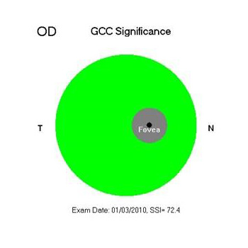 Tomografía Óptica Coherente para seguimiento en glaucoma