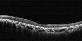 OCT en retinitis pigmentosa