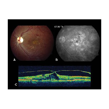 OCT en retinopatía diabética