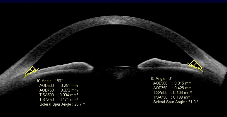OCT para estudio del ángulo en glaucoma