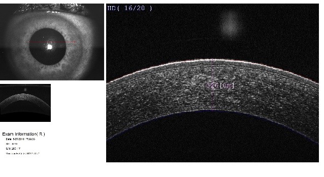 OCT mostrando el estroma de la córnea