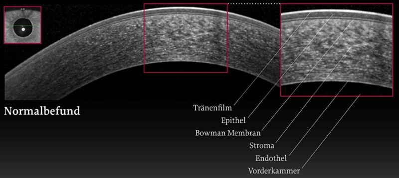 OCT mostrando las diferentes capas de la córnea 