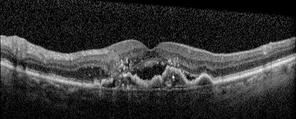 OCT mostrando membrana neo vascular