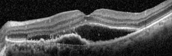 OCT mostrando membrana neo vascular