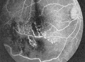 Reporte de Angiografía Fluoresceínica