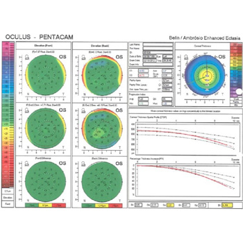Reporte de Pentacam para cirugía refractiva
