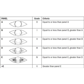 Escala de clasificación en la tinción de la superficie ocular. 