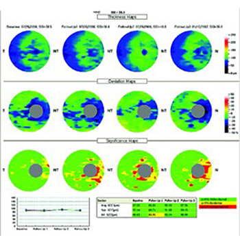 Tomografía OCT, control glaucoma