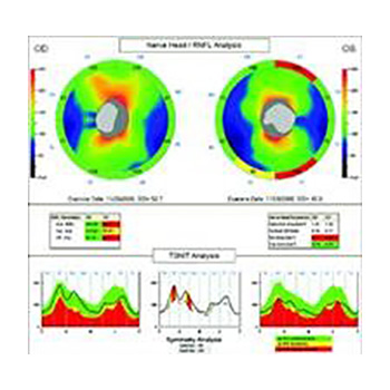 Tomografía Óptica Coherente en glaucoma