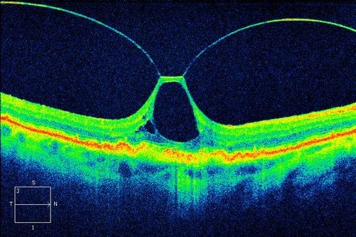 Tomografía Óptica Coherente mostrando agujero macular