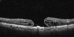 Tomografía Óptica Coherente mostrando agujero macular