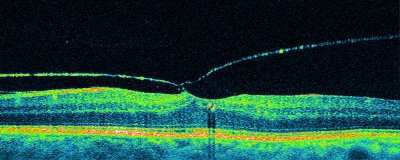 Tomografía Óptica Coherente  mostrando desprendimiento del vítreo posterior