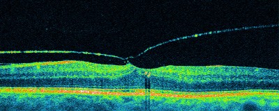 Tomografía Óptica Coherente mostrando desprendimiento del vítreo posterior