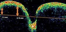 Tomografía Óptica Coherente mostrando drusen de nervio óptico