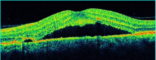 Tomografía Óptica Coherente mostrando edema en retinopatía central serosa