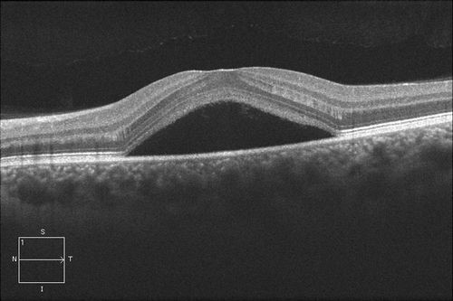 Tomografía Óptica Coherente mostrando edema en retinopatía central serosa