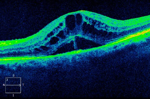 Tomografía Óptica Coherente mostrando edema macular por diabetes