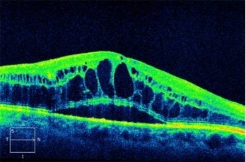 Tomografía Óptica Coherente mostrando edema macular por diabetes