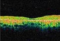 Tomografía Óptica Coherente mostrando maculopatía por cloroquina