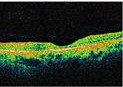 Tomografía Óptica Coherente mostrando maculopatía por cloroquina