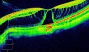 Tomografía Óptica Coherente mostrando membrana epirretiniana