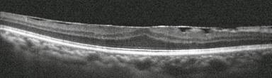 Tomografía Óptica Coherente mostrando membrana epirretiniana