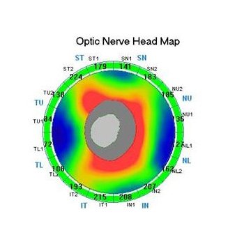 Tomografía Óptica Coherente para seguimiento en glaucoma
