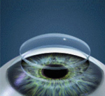 trasplante de cornea